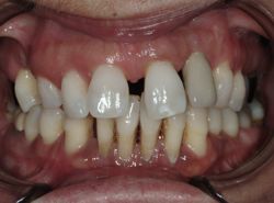 gum_disease_1